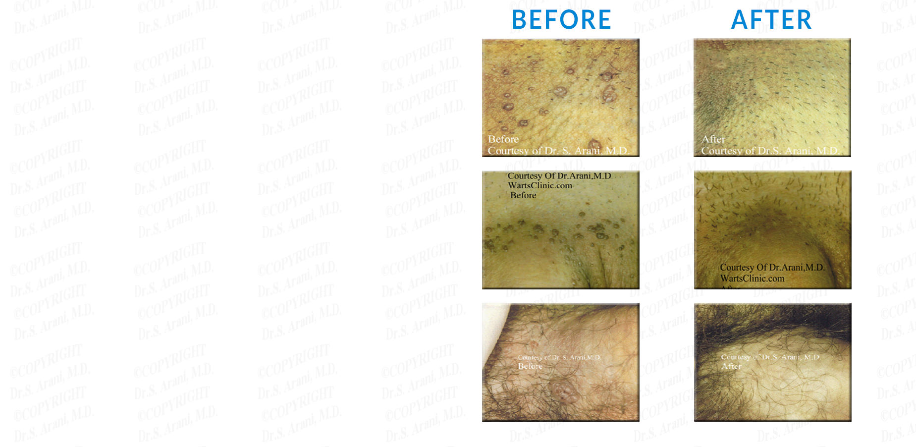 Before and After Photos - Genital Warts Treatment